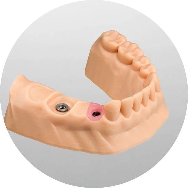 Implant Solution