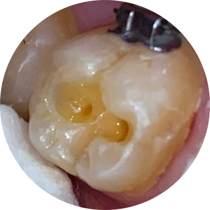 Direct Restorative